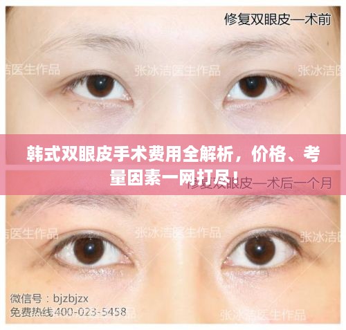 韓式雙眼皮手術(shù)費(fèi)用全解析，價(jià)格、考量因素一網(wǎng)打盡！