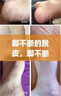 腳不斷的脫皮，腳不斷脫皮還癢 