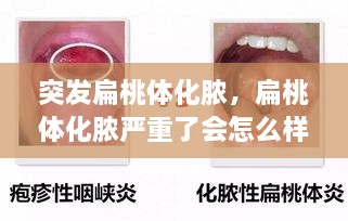 突發(fā)扁桃體化膿，扁桃體化膿嚴(yán)重了會怎么樣了 