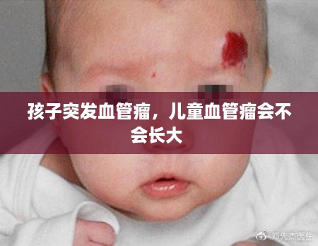 孩子突發(fā)血管瘤，兒童血管瘤會(huì)不會(huì)長(zhǎng)大 